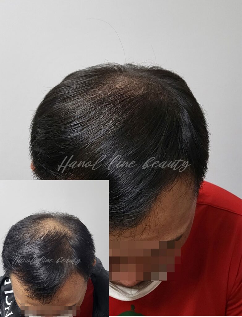 일산smp두피문신