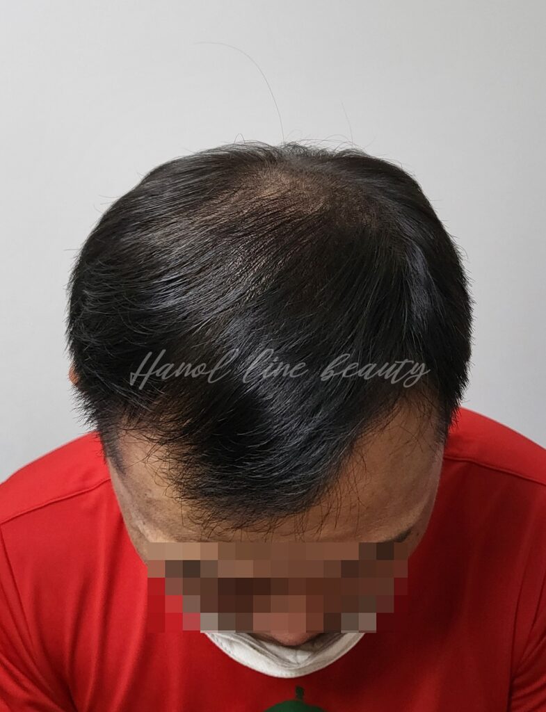 일산두피문신