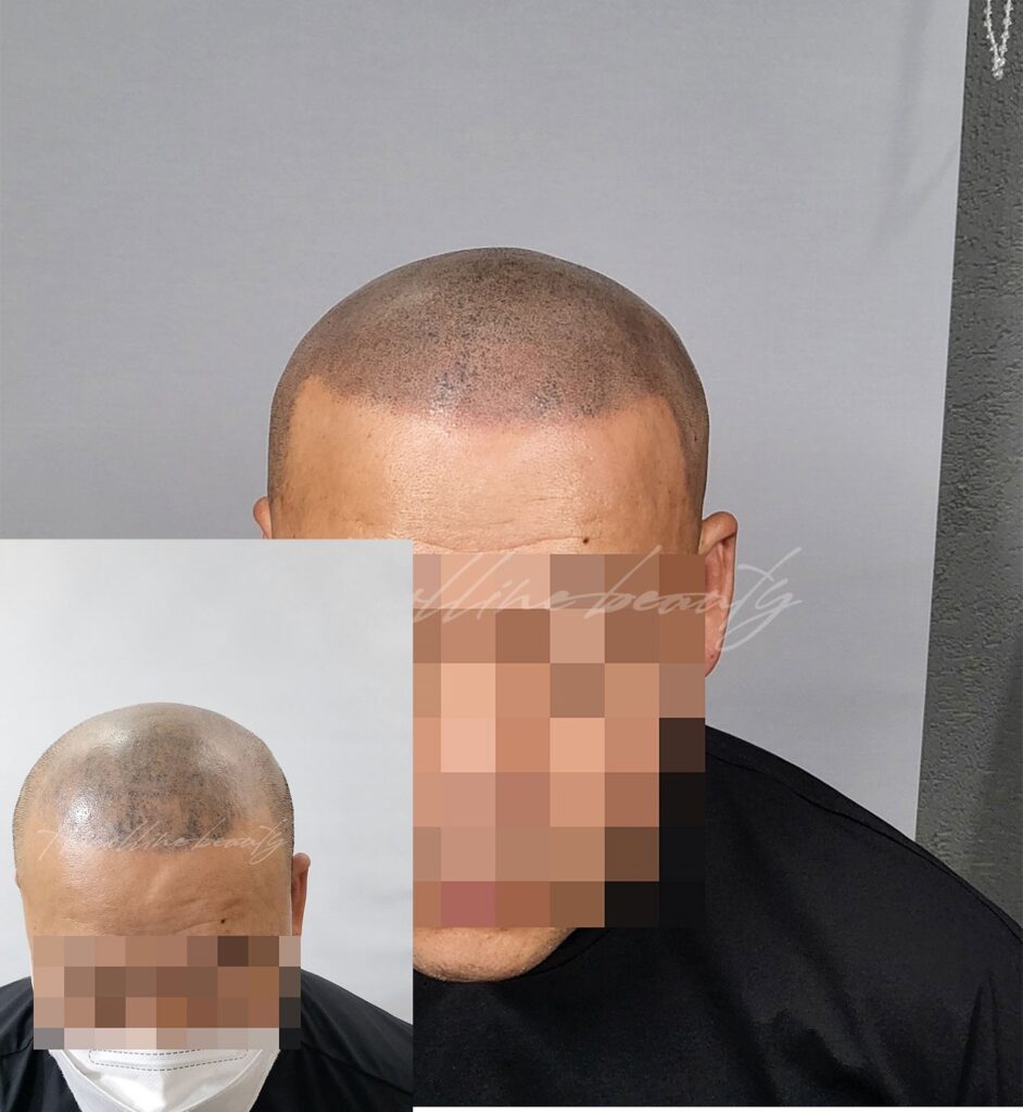 두피문신부작용