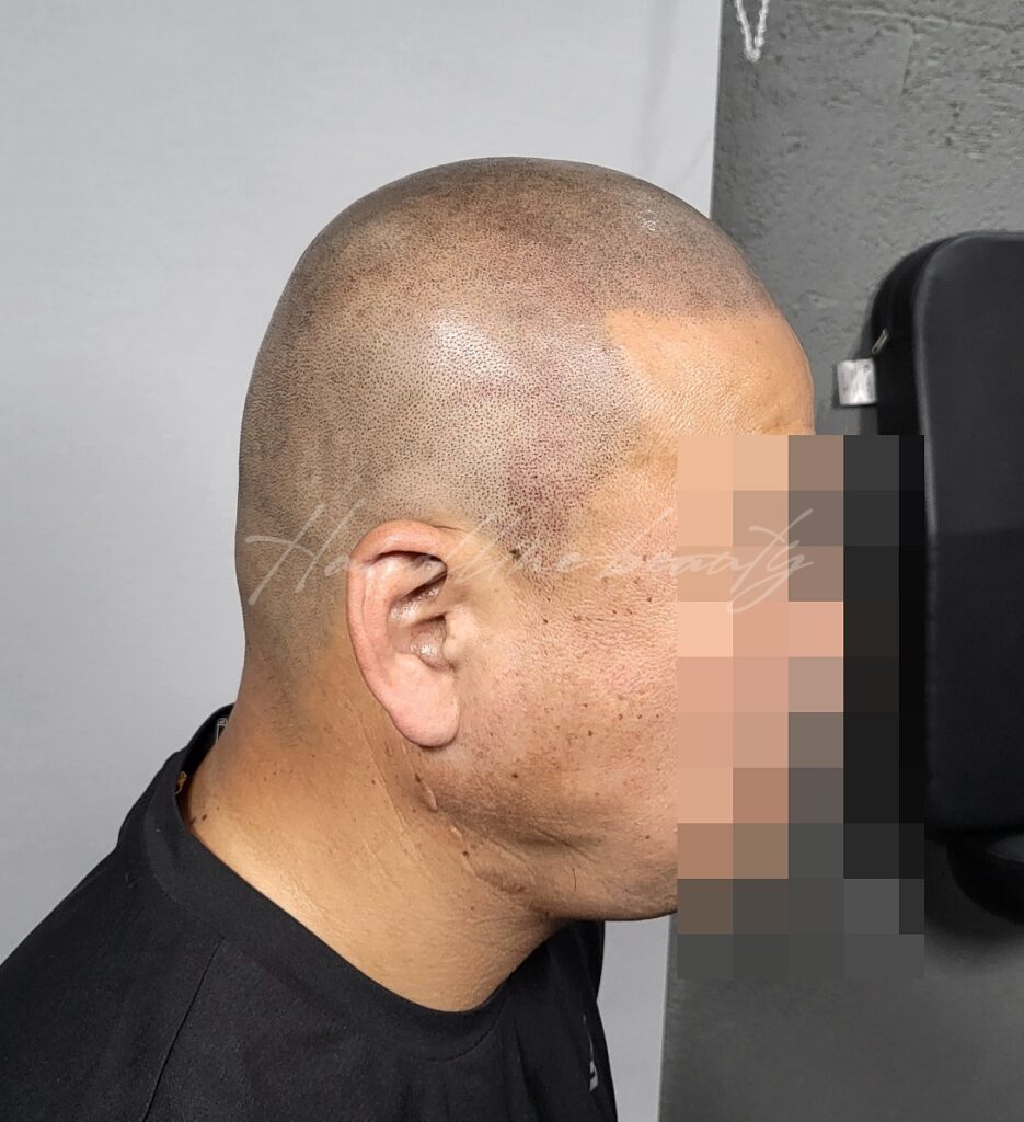 잘못되어진두피문신