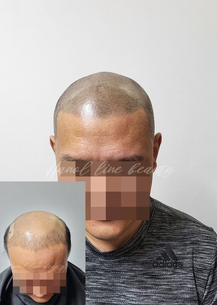 김포smp두피문신