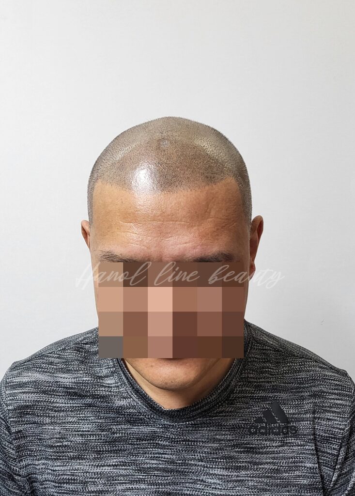 대머리문신