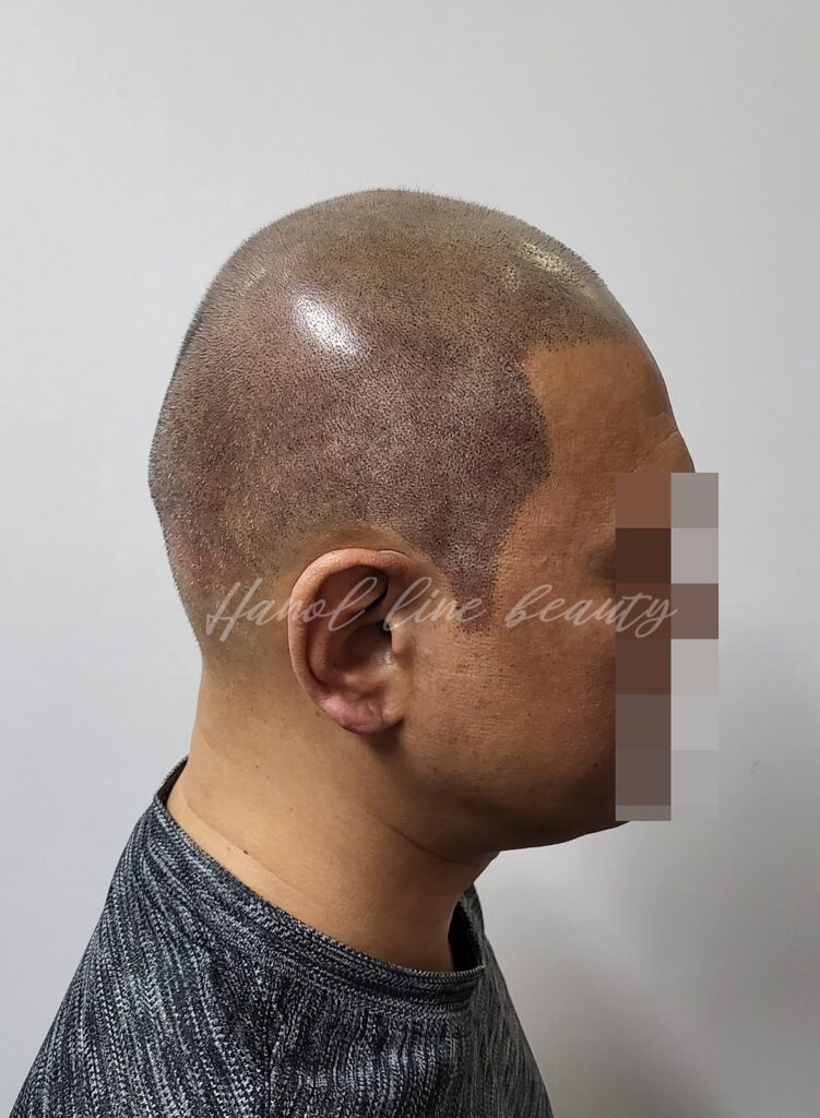 일산두피문신