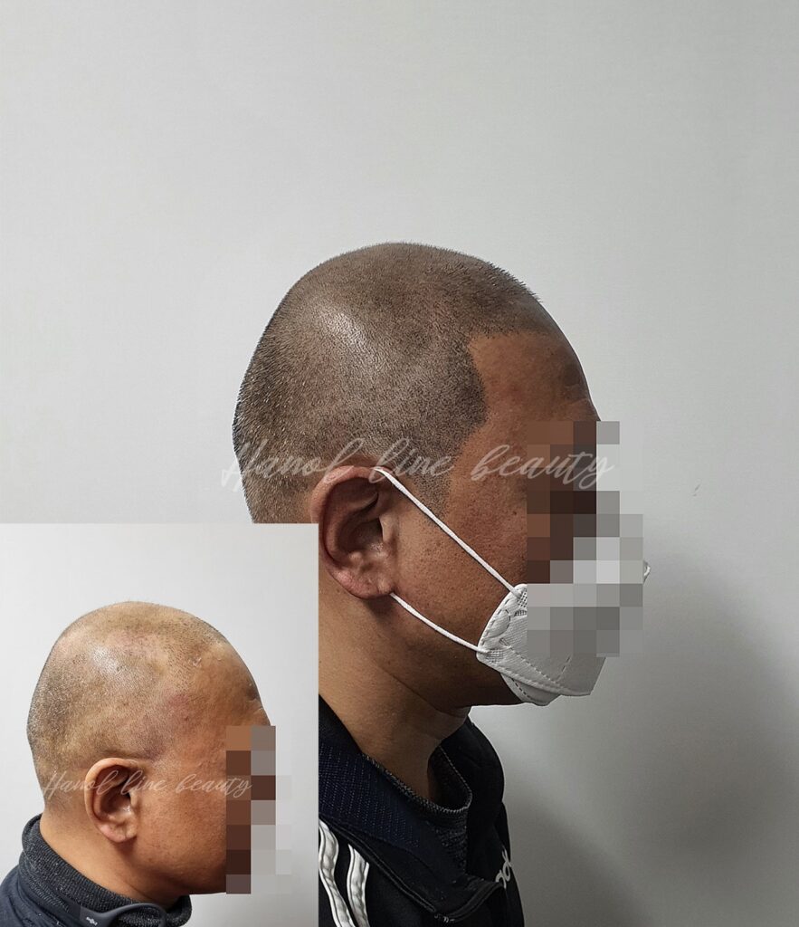 여성두피문신