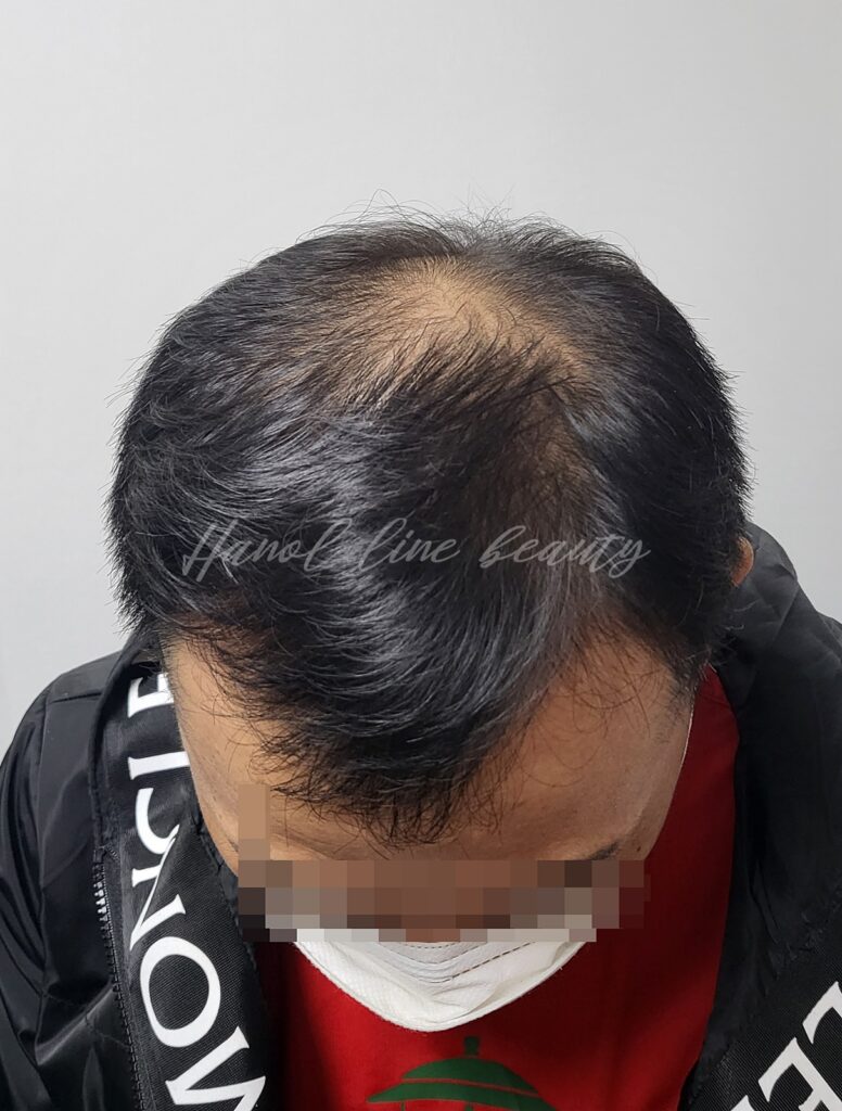 일산두피타투