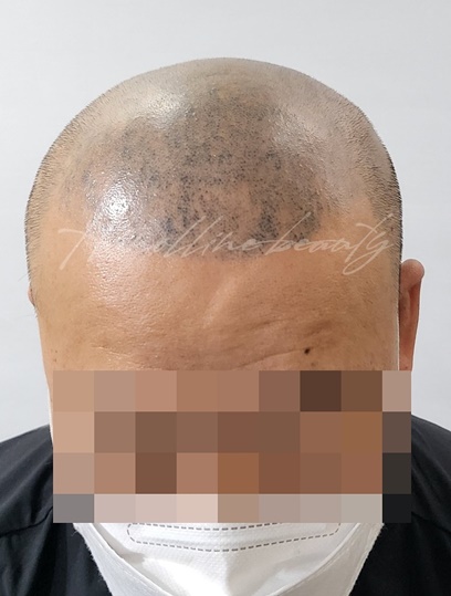 일산두피문신
