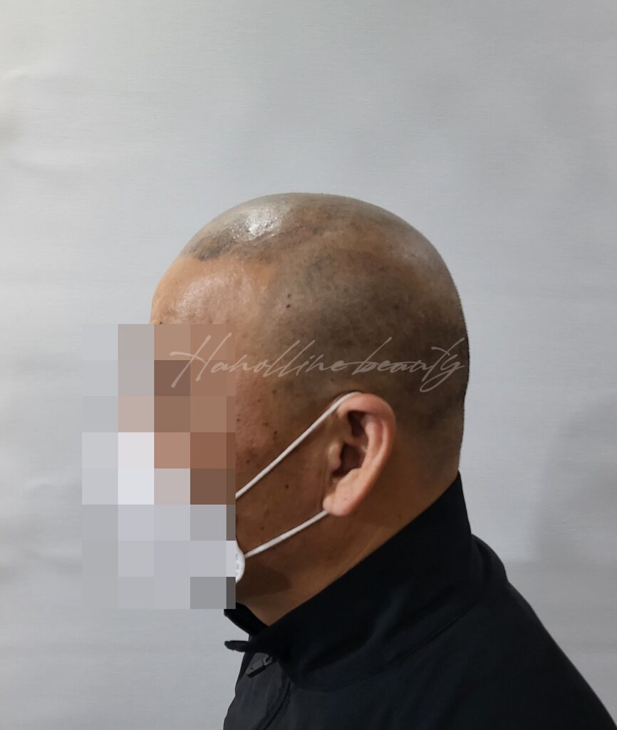 일산smp두피문신